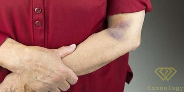 Causes of Blue Spots Appearing on the Skin